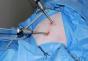 Borttagning av livmodern med den laparoskopiska metoden: postoperativ period, konsekvenser, recensioner