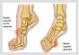 Što učiniti ako vam je noga uganuta u području gležnja: pravila liječenja ovisno o težini uganuća gležnja