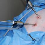 Odstranění dělohy laparoskopickou metodou: pooperační období, důsledky, recenze