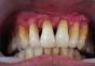 Marginális parodontitis kezelése