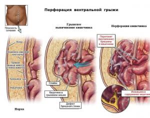 Hernia ventrale abdominale postoperative: metodat e trajtimit dhe rehabilitimit