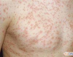 Differenza tra varicella e morbillo