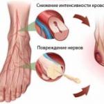 Какво е лечението на парезата на краката?