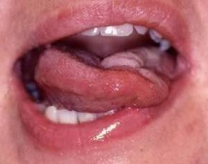 Бульбарный синдром: причины, симптомы, особенности лечения патологии у детей и взрослых Паралич языка развивается при