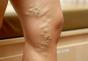 Těžkost v nohou pod kolenem a způsoby její léčby