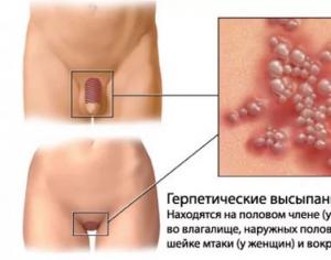 Come trattare l'herpes genitale a casa